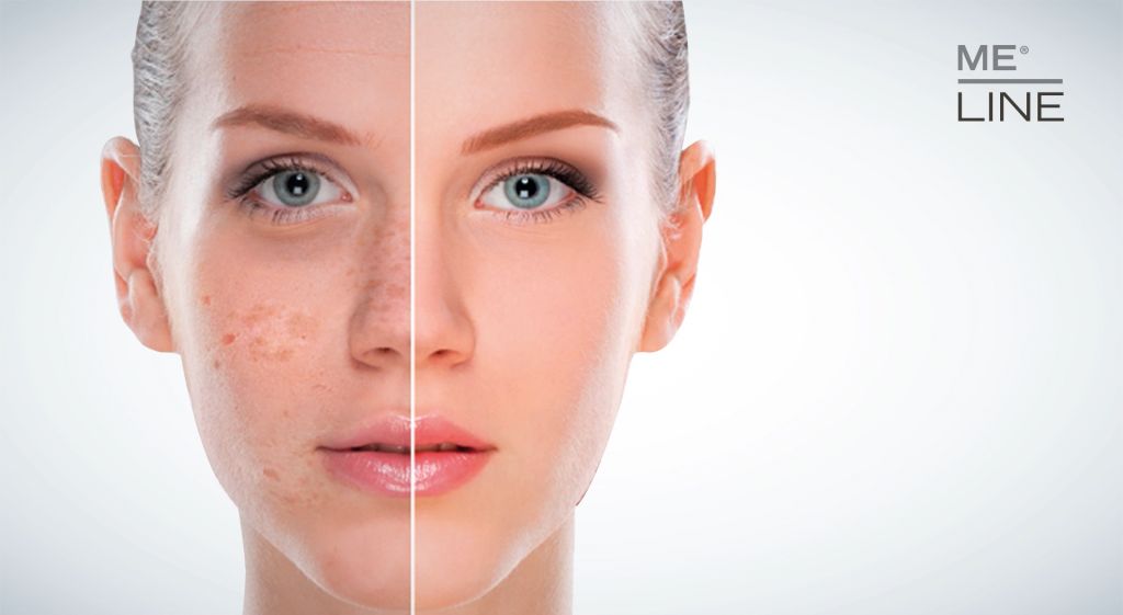 SKIN HYPERPIGMENTATION