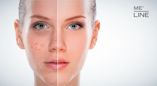 SKIN HYPERPIGMENTATION