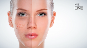 SKIN HYPERPIGMENTATION